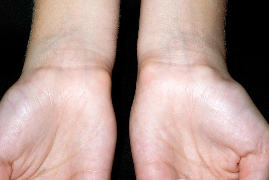 Prominent Wrist Bones Photograph by Dr P. Marazzi/science Photo Library