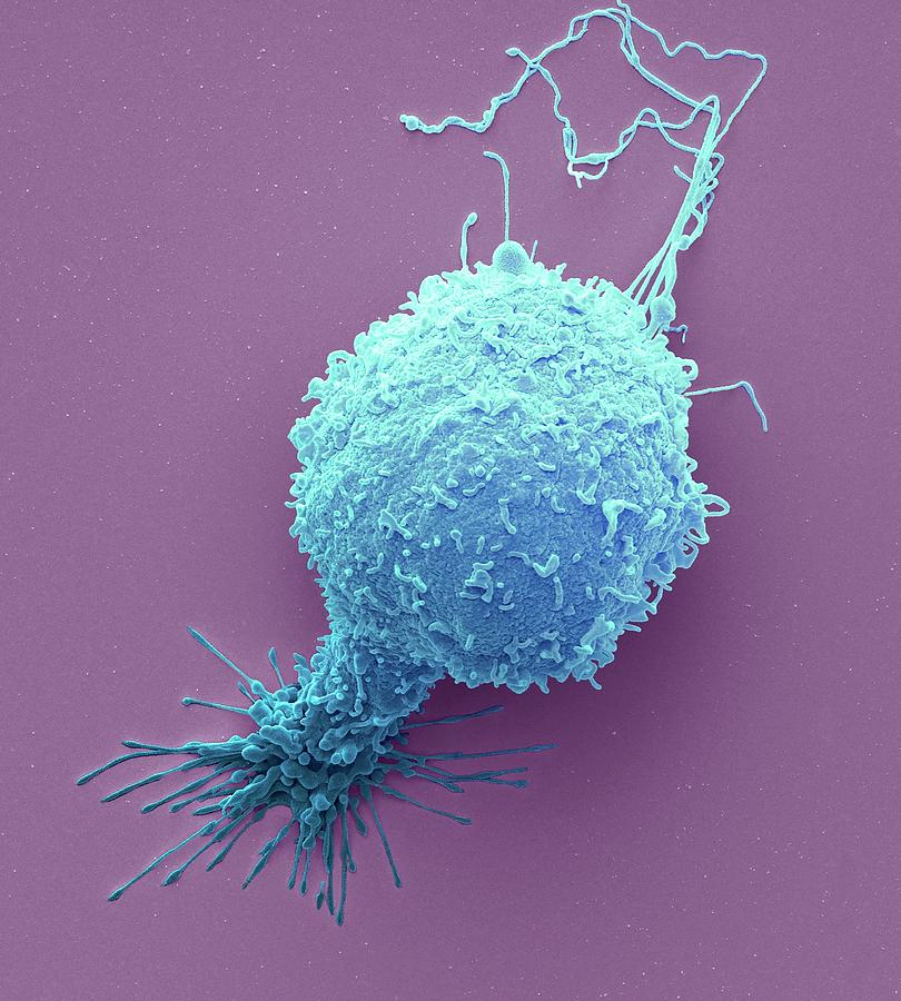 Prostate Cancer Cell Photograph By Steve Gschmeissner 5111
