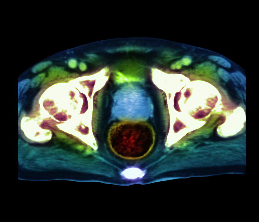 Prostate Cancer Photograph by Simon Fraser/science Photo Library ...