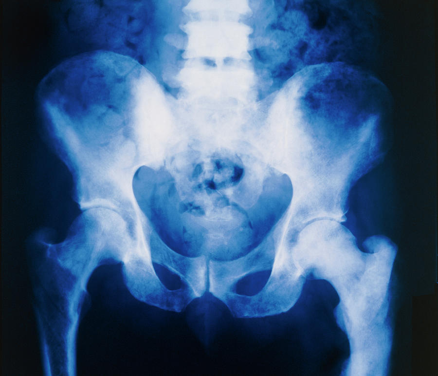 Prostate Cancer X Ray Of Secondary Bone Tumours Photograph By Science 7757