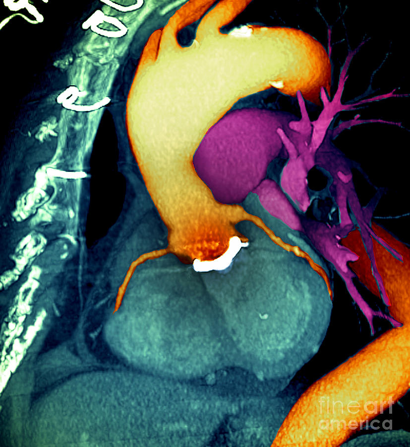 Prosthetic heart valve 3D CT Scan Photograph by Spl