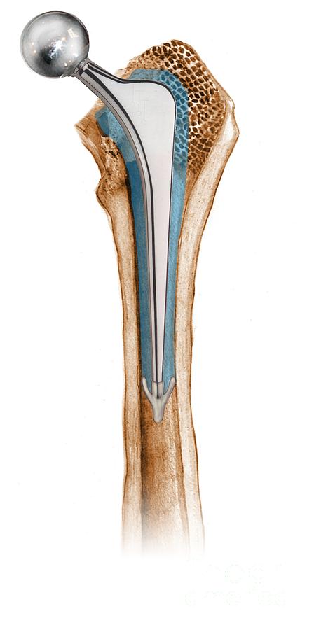 Prosthetic hip image