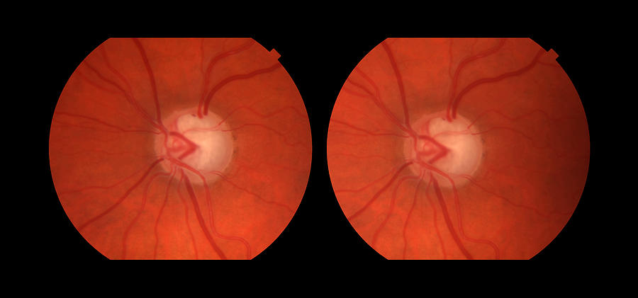 Pseudoexfoliative Glaucoma, Stereo Image Photograph by Paul Whitten