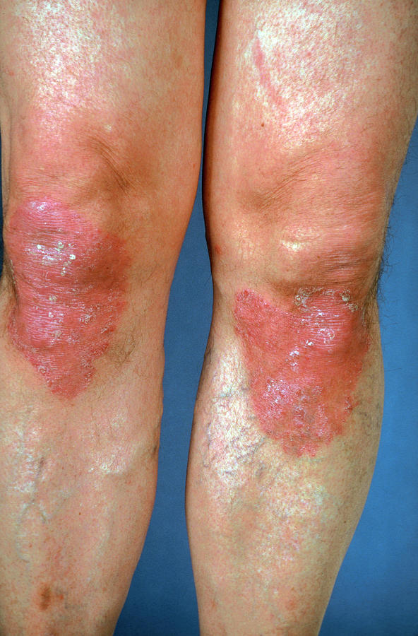 Psoriasis Affecting Both Knees Photograph By James Stevensonscience