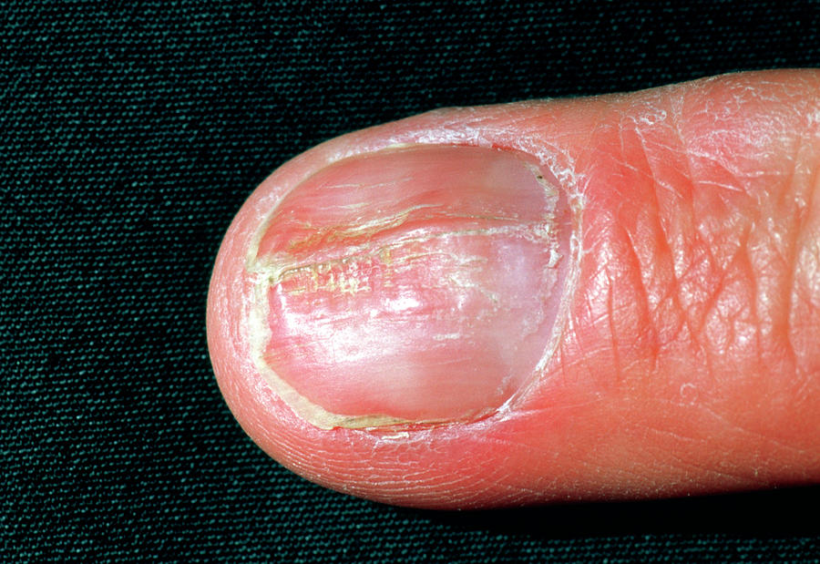 Psoriasis Affecting The Fingernail Photograph by Dr P. Marazzi/science ...