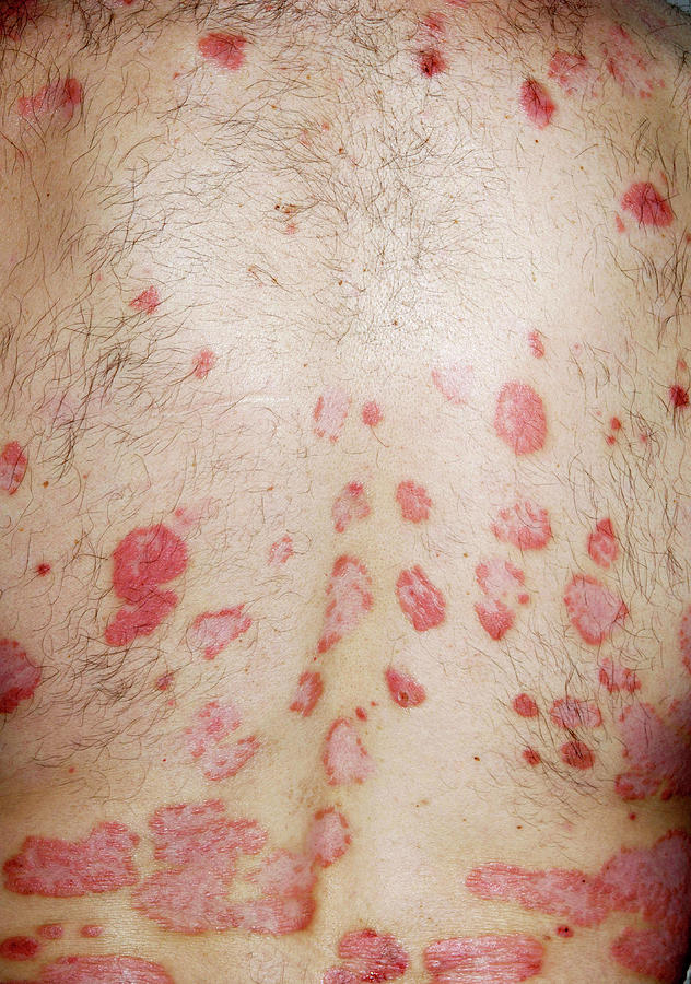 Psoriasis After 2 Weeks Of Treatment Photograph By Dr P Marazzi