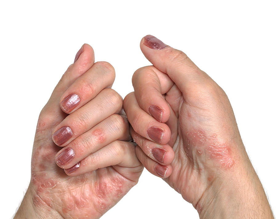 Psoriasis Hand Photograph by Petekarici