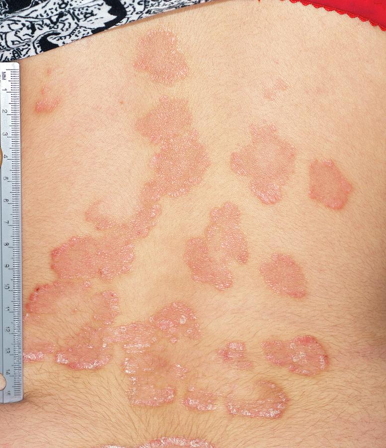 Psoriasis On The Back After Treatment Photograph By Dr Harout Tanielian