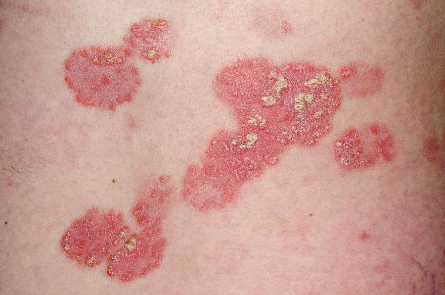 Psoriasis On The Skin Before Lithium Photograph by Dr P. Marazzi ...