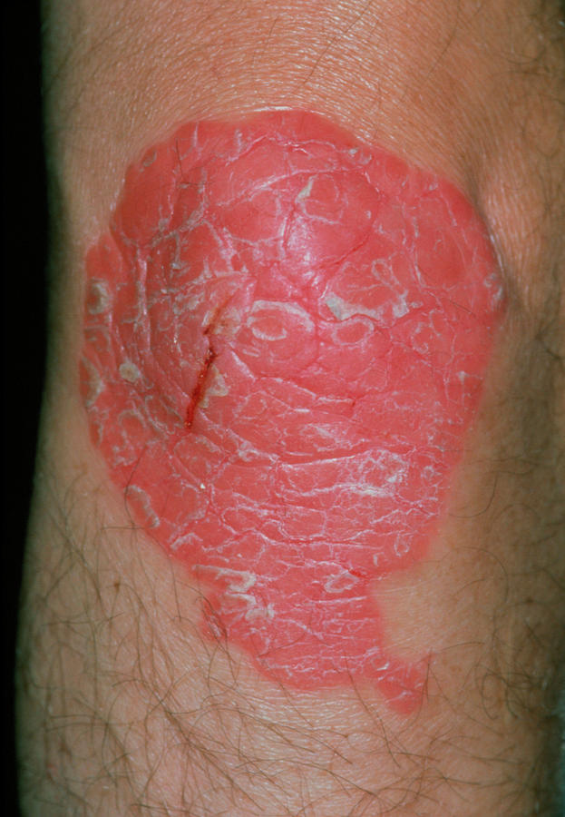 Psoriasis On The Skin Of The Knee Photograph by Dr P. Marazzi/science ...