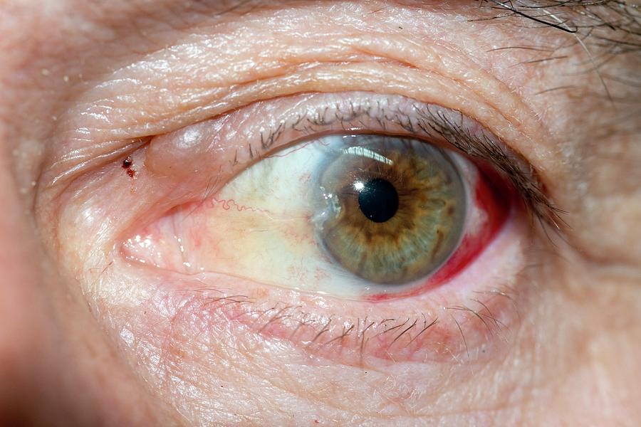 Pterygium Eye Disorder Photograph by Dr P. Marazzi/science Photo Library