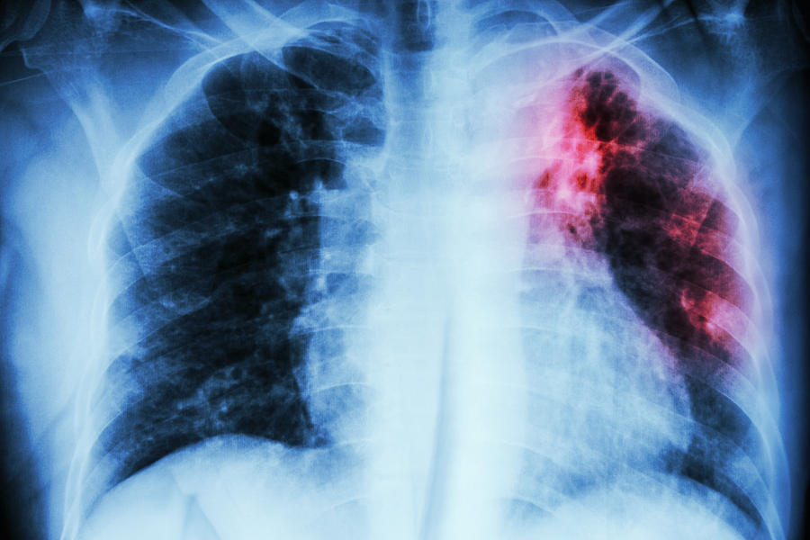Pulmonary Tuberculosis Photograph by Stockdevil
