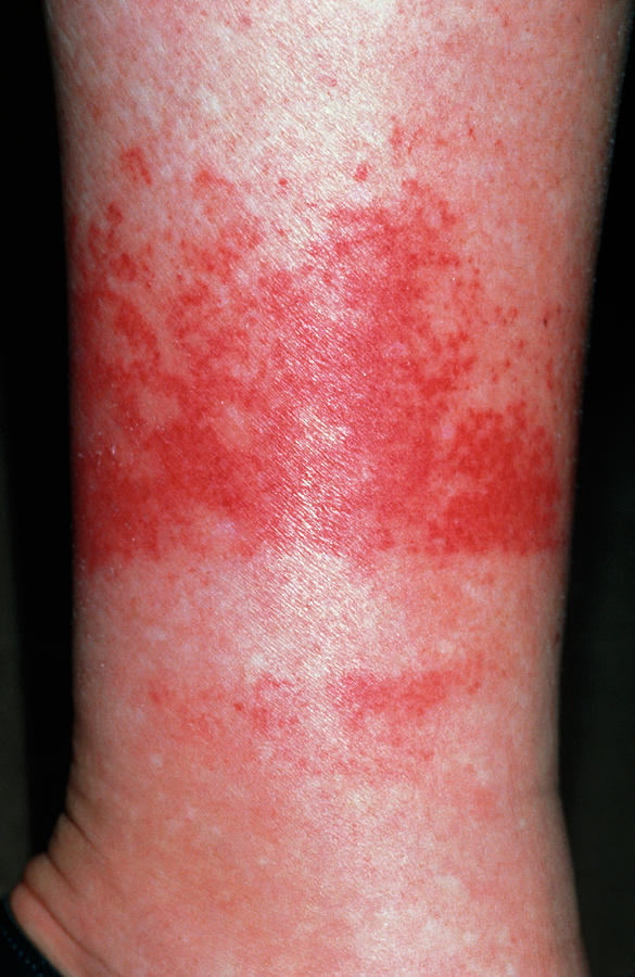 Non Itchy Red Rash On Lower Legs Above Ankles