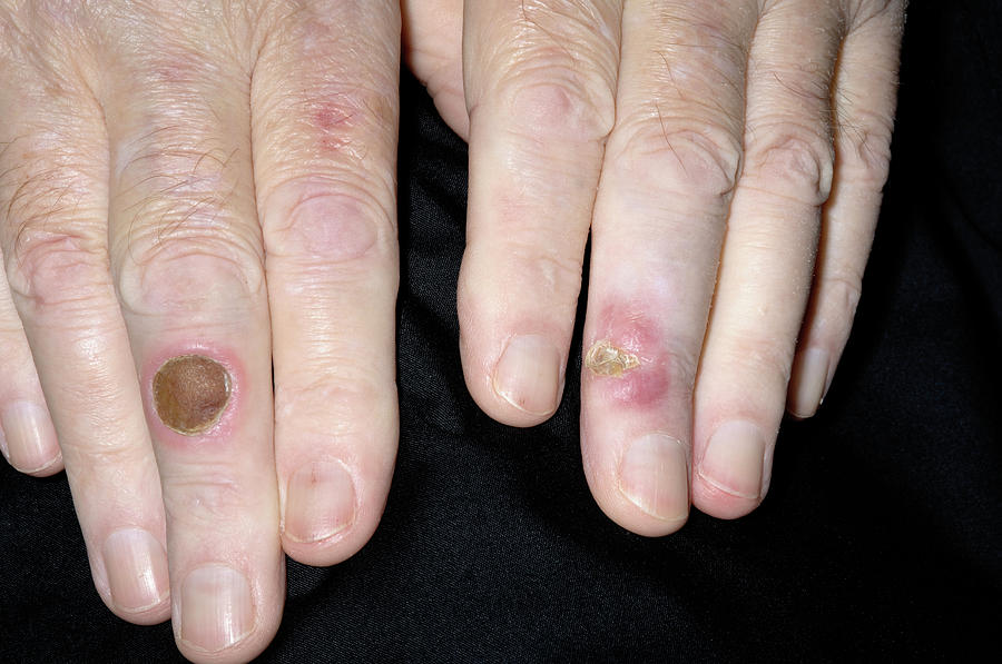 Pyoderma Ulcers Photograph by Dr P. Marazzi/science Photo Library