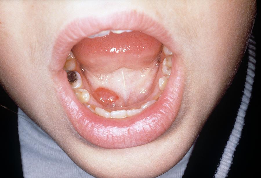 Ranula In A Mouth Photograph by Clinica Claros/science Photo Library
