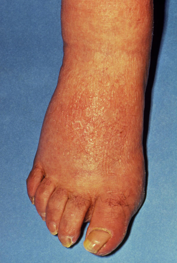 Rash & Swelling On Foot Due To Secondary Syphilis Photograph by Science Photo Library