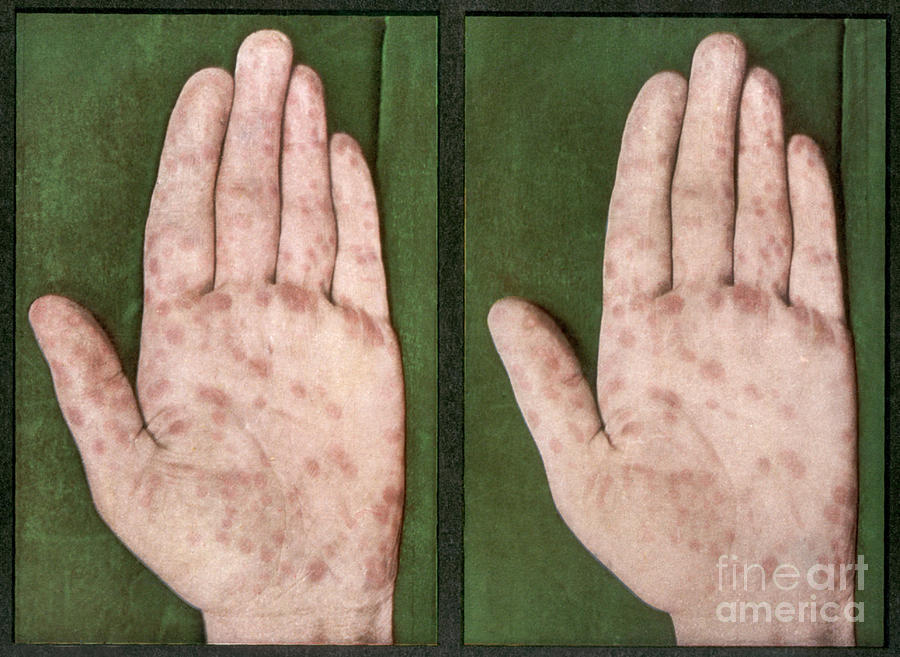 Rash Caused By Syphilis, Vintage Photograph by DoubleVision