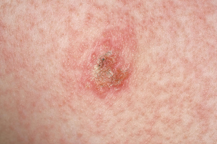 Rash In Mastocytosis Photograph by Dr P. Marazzi/science Photo Library