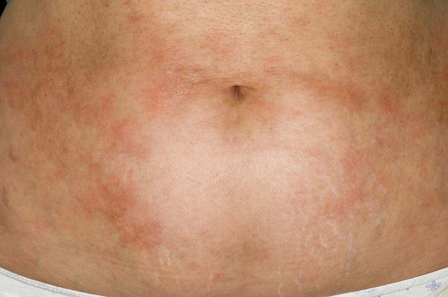 Rash On Abdomen After Cancer Treatment Photograph By Dr P Marazzi 