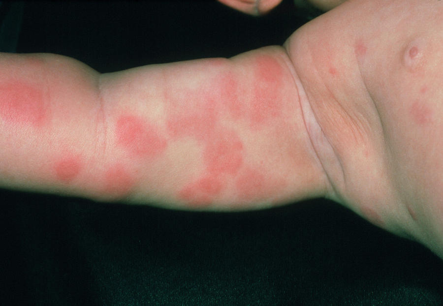 Rash On Babys Arm Due To Food Allergy Photograph By Dr P Marazzi