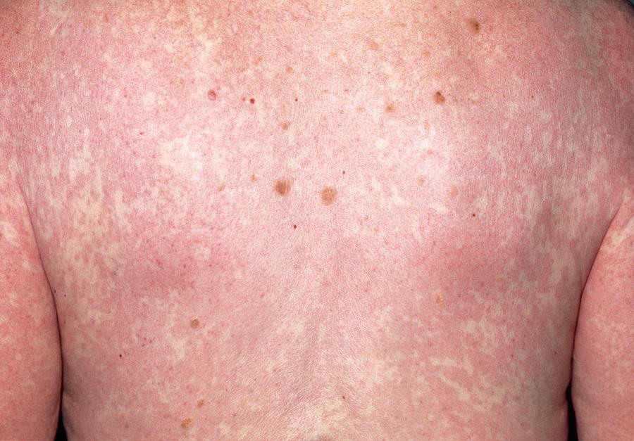 Rash Over Back Due To Allergy To Carbamazepine Photograph By Dr P Marazziscience Photo Library 