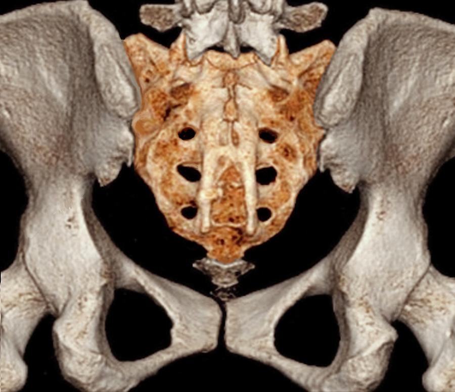 Pelvis Photograph - Rear Of Pelvis And Base Of Spine by Zephyr/science Photo Library