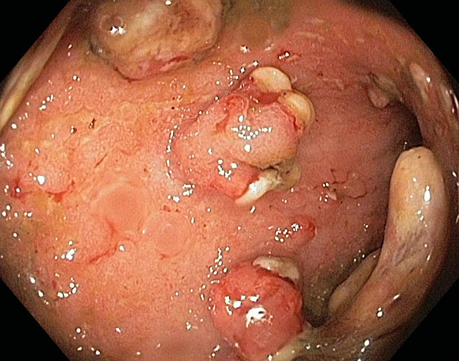 Ulcerative Colitis Photograph - Rectal Polyps by Gastrolab