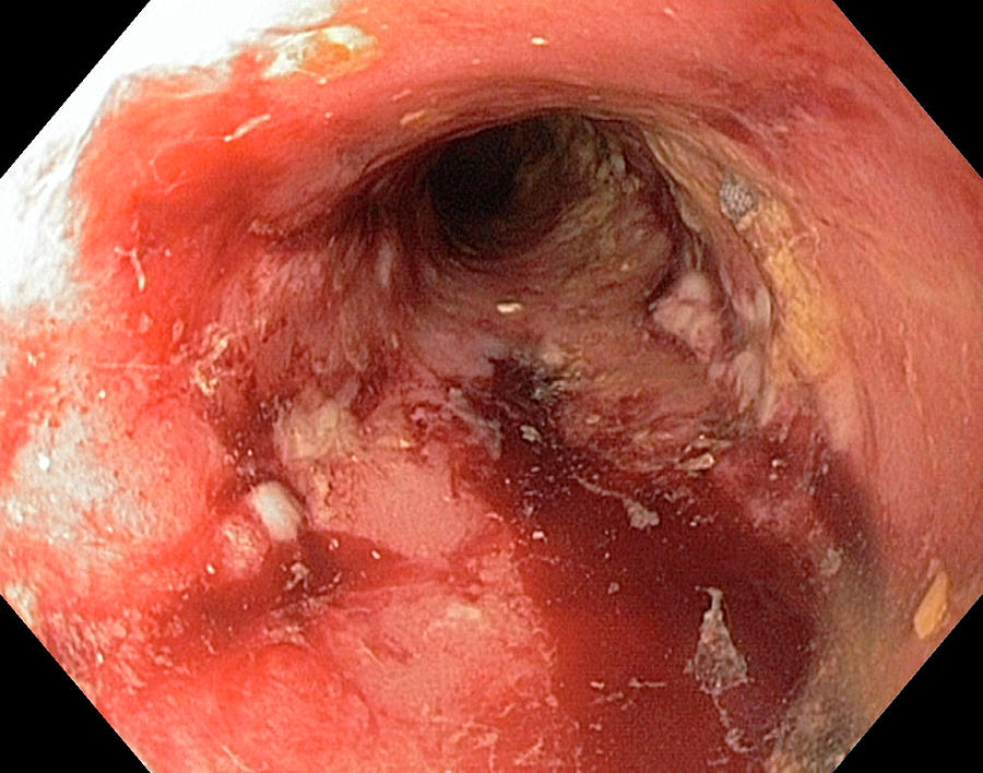 Rectal Stricture In Crohns Disease Photograph by Gastrolab