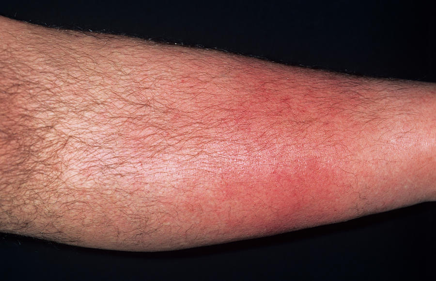 Recurrent Cellulitis Photograph By Dr P Marazziscience Photo Library