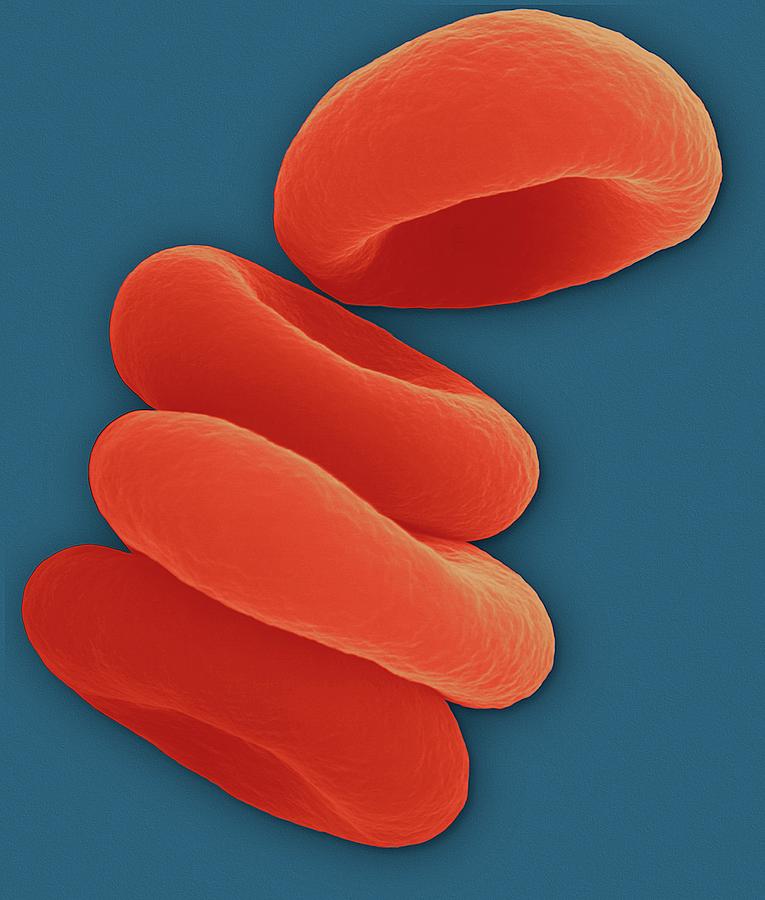 Red Blood Cells In The Rouleau Formation Photograph by Dennis Kunkel Microscopy/science Photo Library