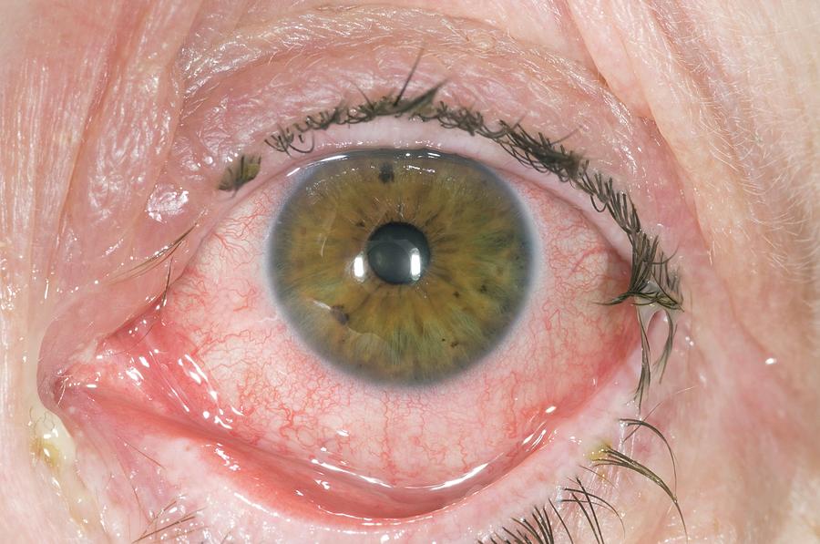 red-eye-from-bacterial-conjunctivitis-photograph-by-dr-p-marazzi