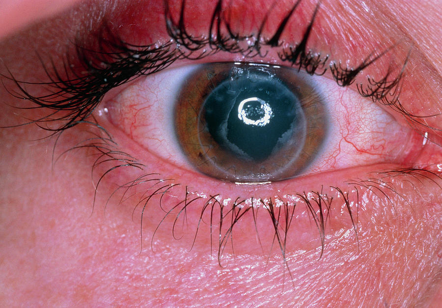 Rejecting Corneal Graft In Man's Eye Photograph by Science Photo Library