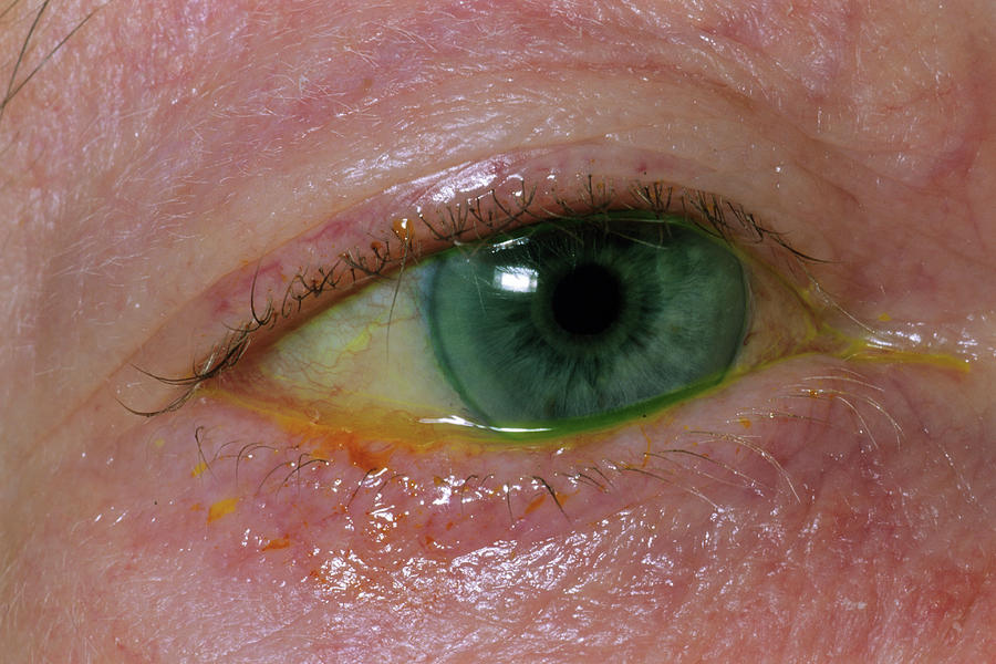 Removal Of Foreign Body In Eye Photograph by Dr P. Marazzi/science ...