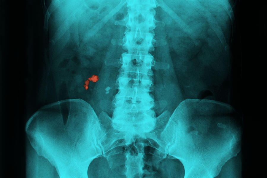 Renal lithiasis,x-ray Photograph by Bsip