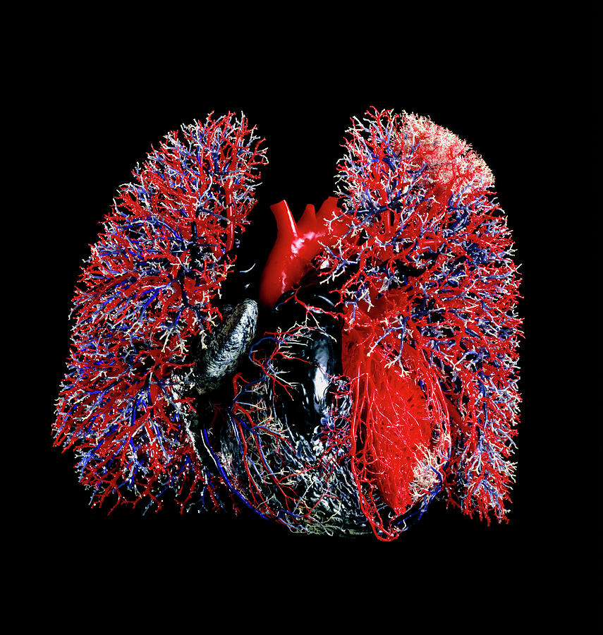 Resin Cast Of The Blood Vessels Of Heart & Lungs Photograph by Martin Dohrn/royal College Of Surgeons/ Science Photo Library.
