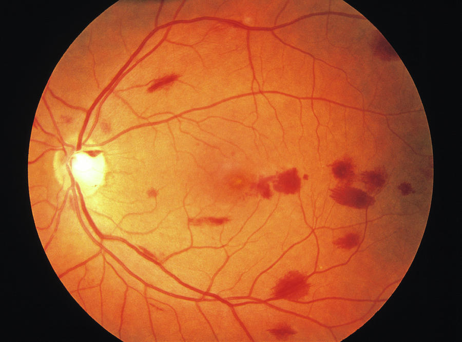 Retina Damage In Leukaemia Photograph by Sue Ford/science Photo Library