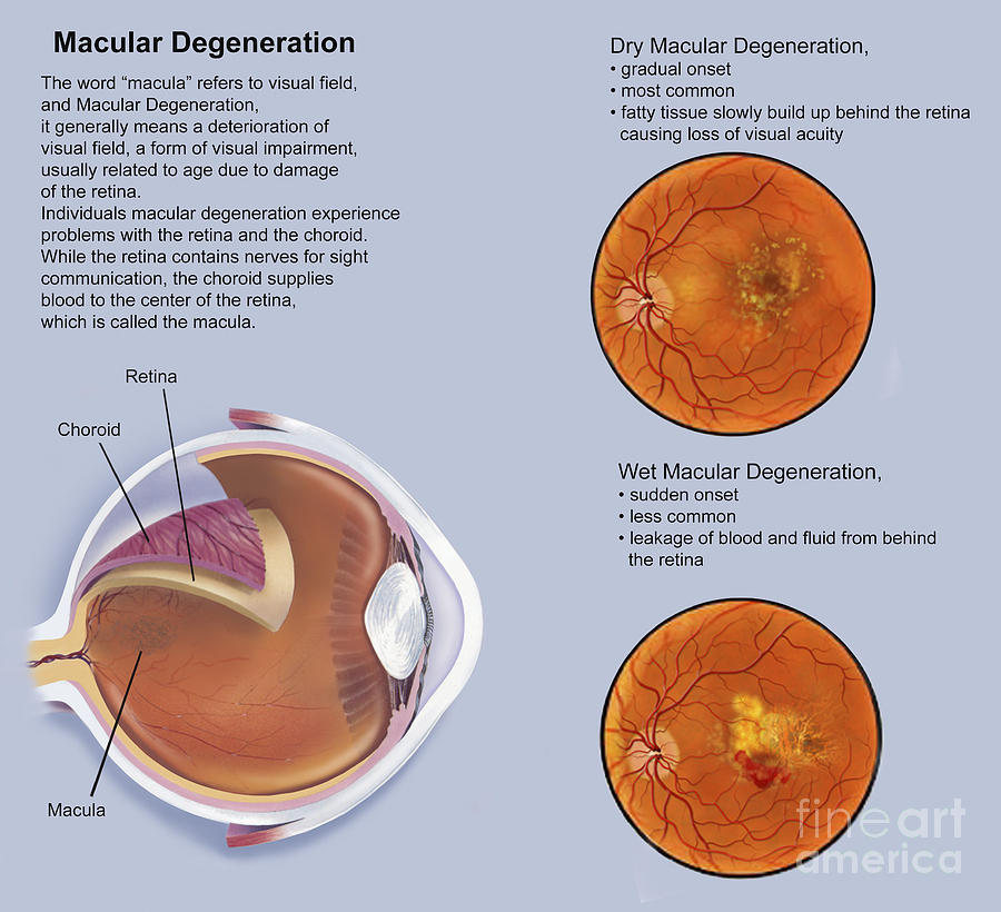 Retina With Macular Degeneration Digital Art by TriFocal Communications ...