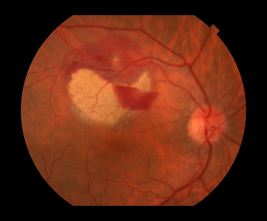 Retinal Artery Macroaneurysm Photograph by Paul Whitten