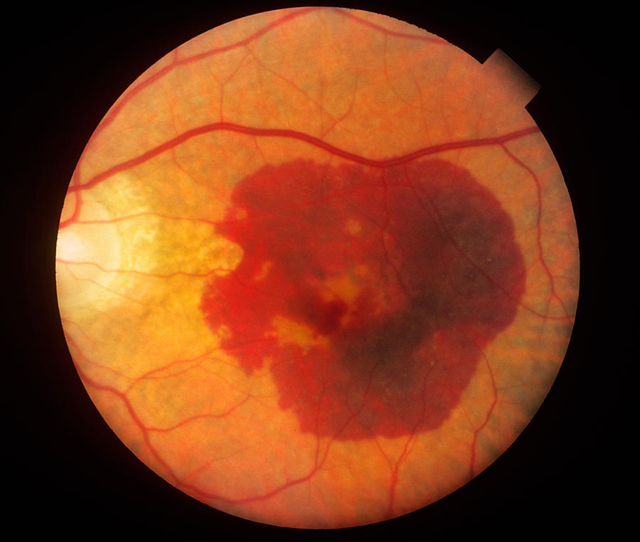 eye-hemorrhage-provisu