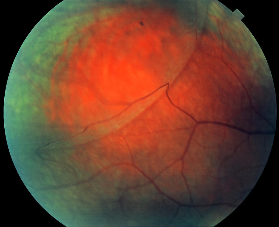eye retina picture
