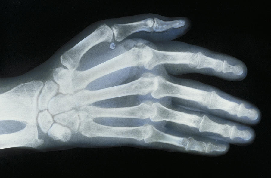 Rheumatoid Arthritis Photograph by Chris Bjornberg