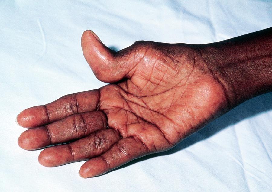 Rheumatoid Arthritis In Hands Of Jamaican Patient Photograph By Sue ...