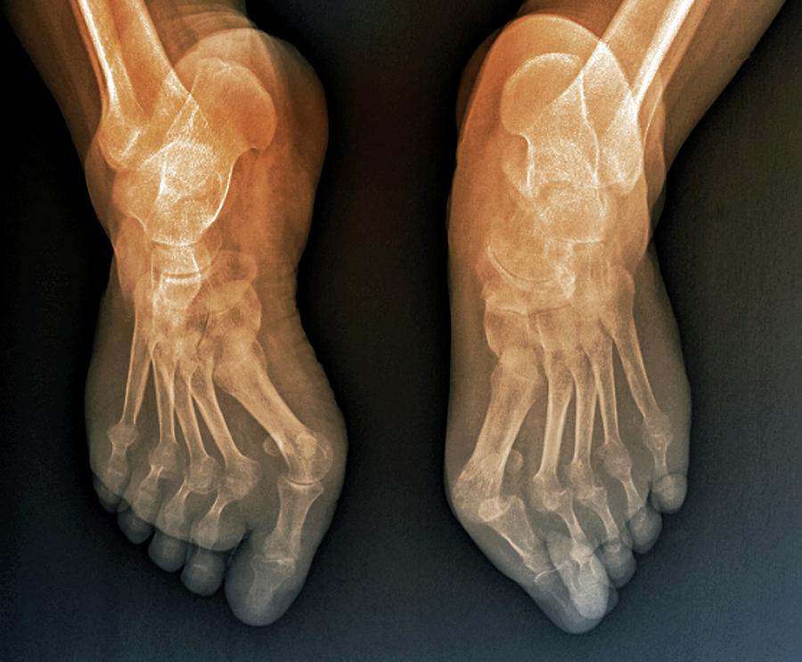 Rheumatoid Arthritis Of The Feet Photograph by Zephyr/science Photo ...