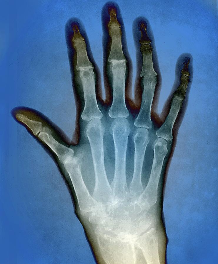 Rheumatoid Arthritis Of The Hand Photograph by Zephyr