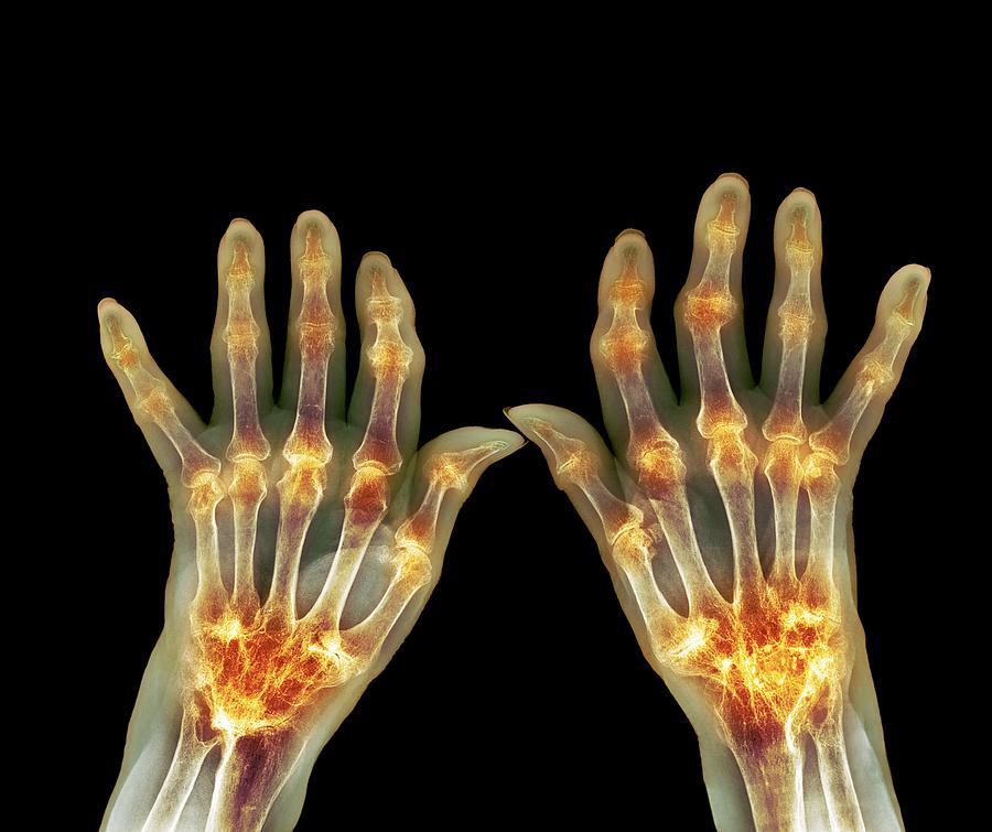 Rheumatoid arthritis, X-ray Photograph by Science Photo Library