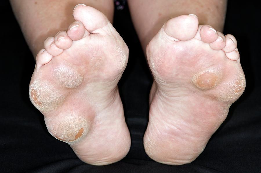 rheumatoid-nodules-on-soles-of-feet-photograph-by-dr-p-marazzi-science