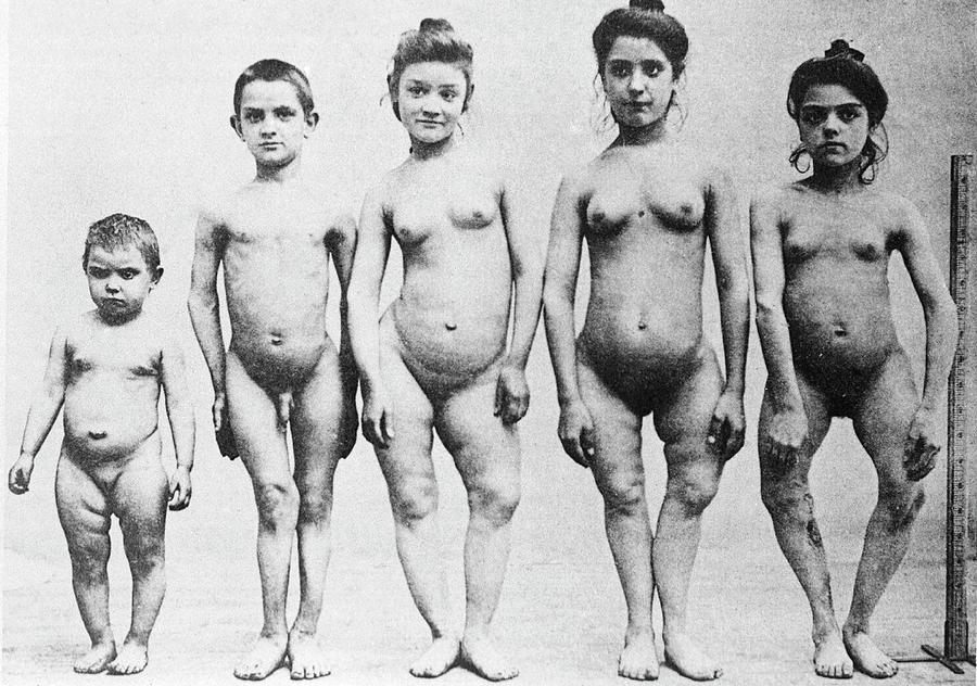Paris Photograph - Rickets Patients by National Library Of Medicine