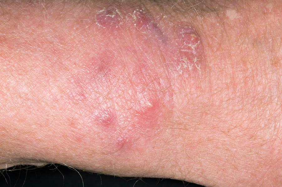 Fungal Rash On Skin