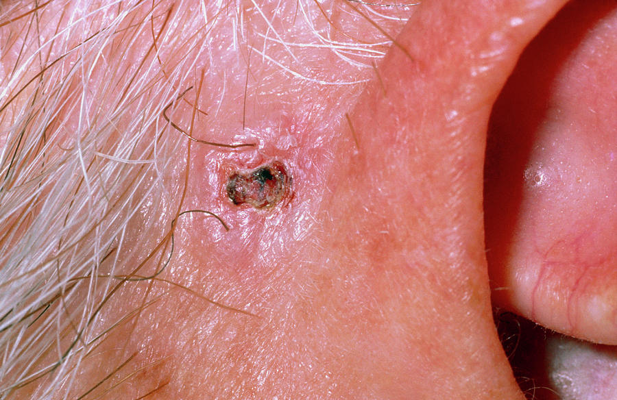 Rodent Ulcer Next To Ear Photograph By Dr P Marazziscience Photo Library