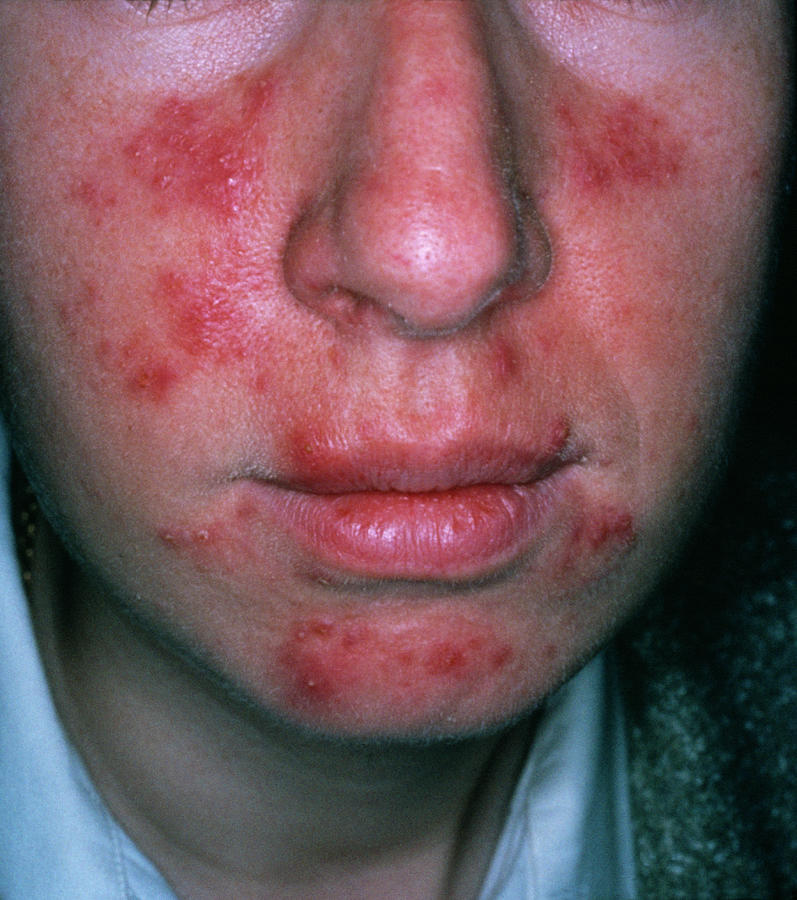 Rosacea Photograph by Cnri/science Photo Library - Pixels